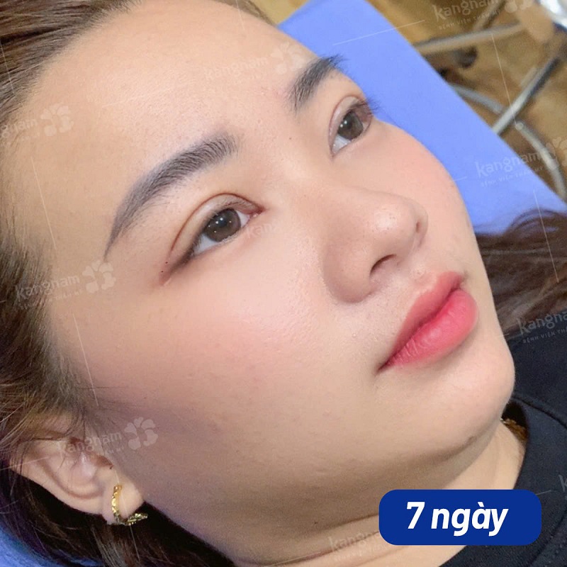 Mí mắt hết sưng tấy sau khoảng 7 ngày cắt mí