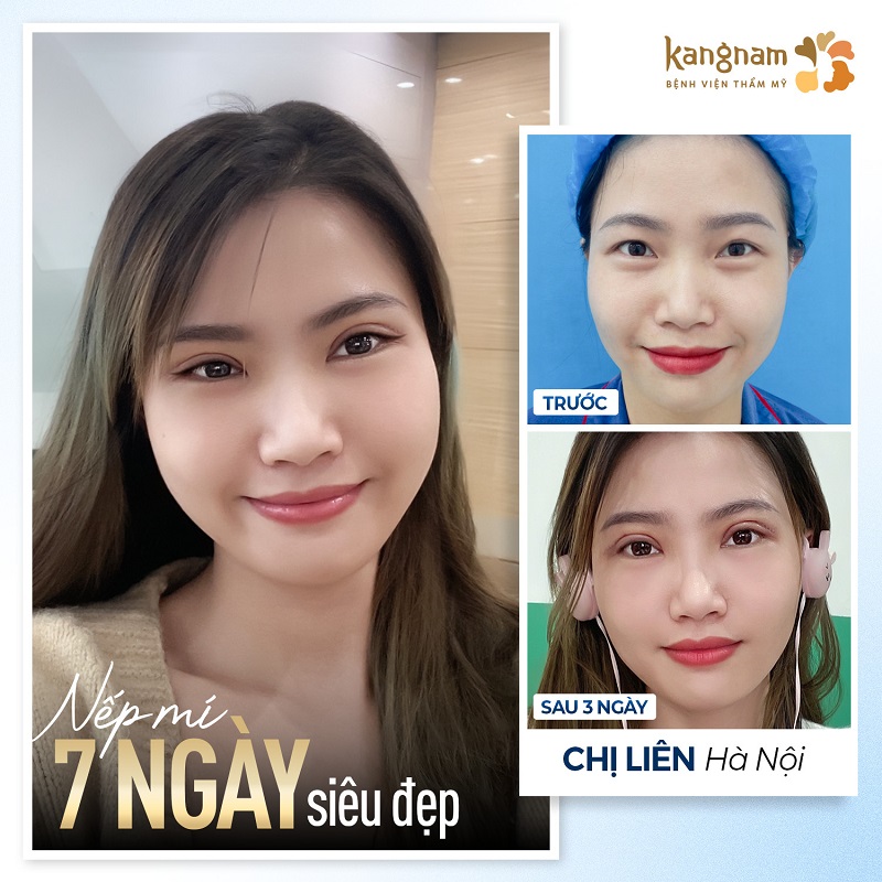 Nếp mí ổn định, vào form tự nhiên và hết sưng chỉ sau 7 ngày cắt mí
