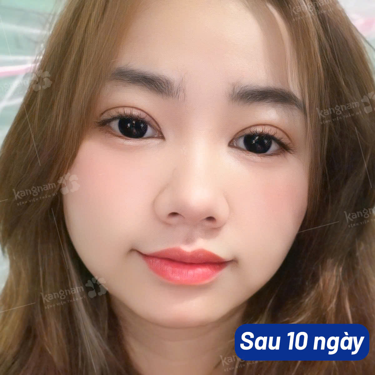 Nếp mí ổn định sau khoảng 10 ngày