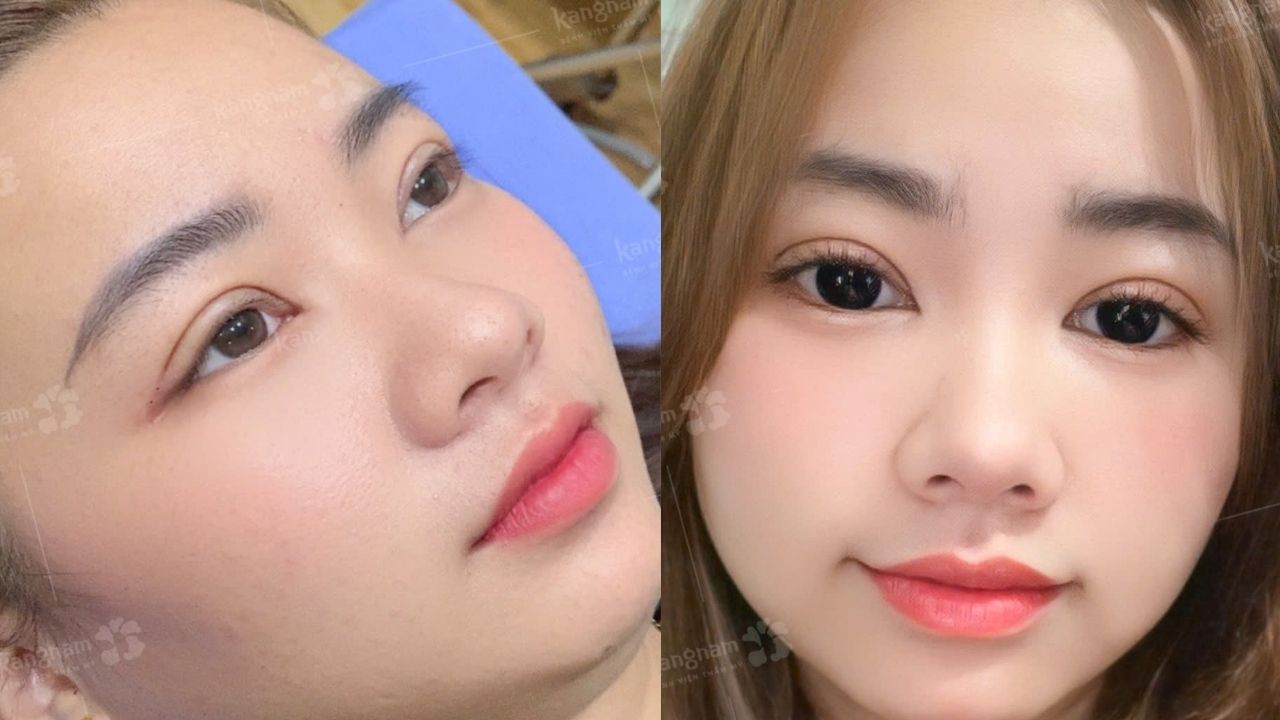 Cắt mí mắt bao lâu thì hết sưng? Hướng dẫn cách chăm sóc