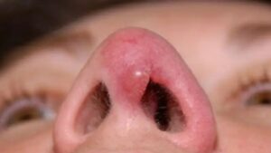 Dấu hiệu mũi không hợp sụn: Gợi ý 6 dấu hiệu quan trọng