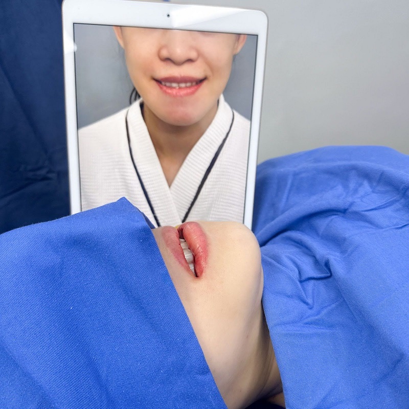 Hình ảnh khách hàng ngay sau khi vừa chỉnh Hàm móm