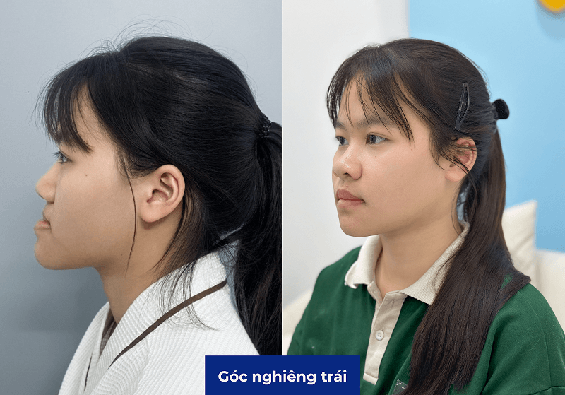 Các bác sĩ tính toán các chỉ số để gương mặt hài hòa, tự nhiên