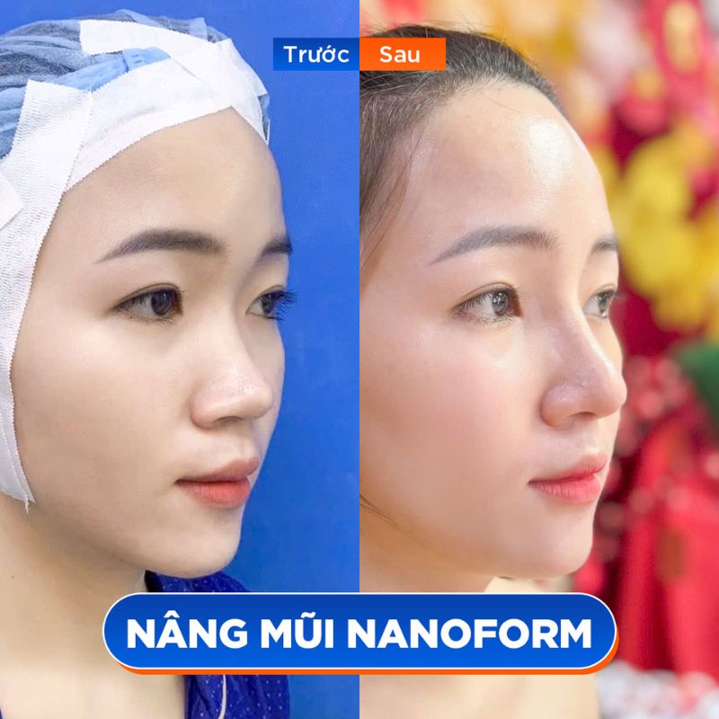 Sử dụng sụn phù hợp để tránh tình trạng không tương thích