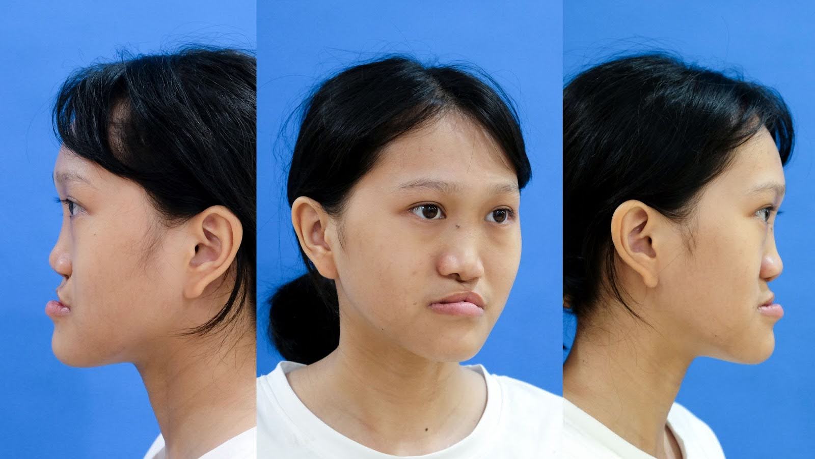 Xuân Mai trước khi đến với Thẩm mỹ Kangnam