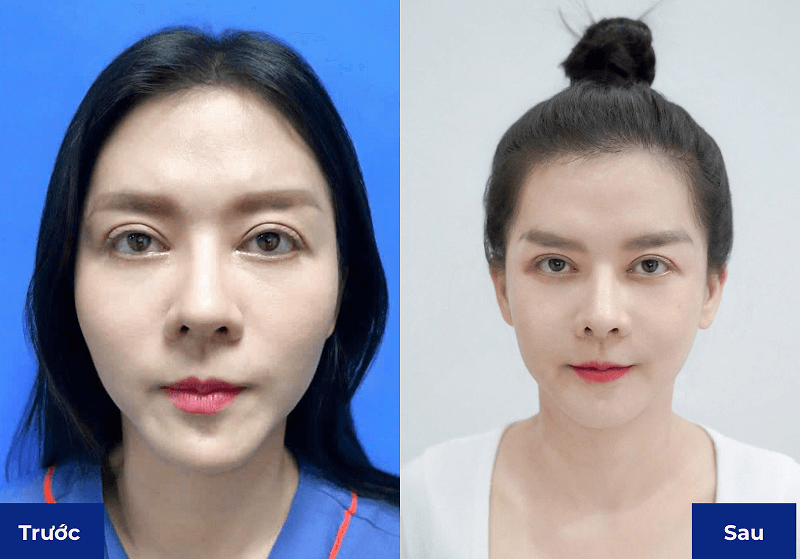 Hình ảnh khách hàng trước và sau gọt hàm