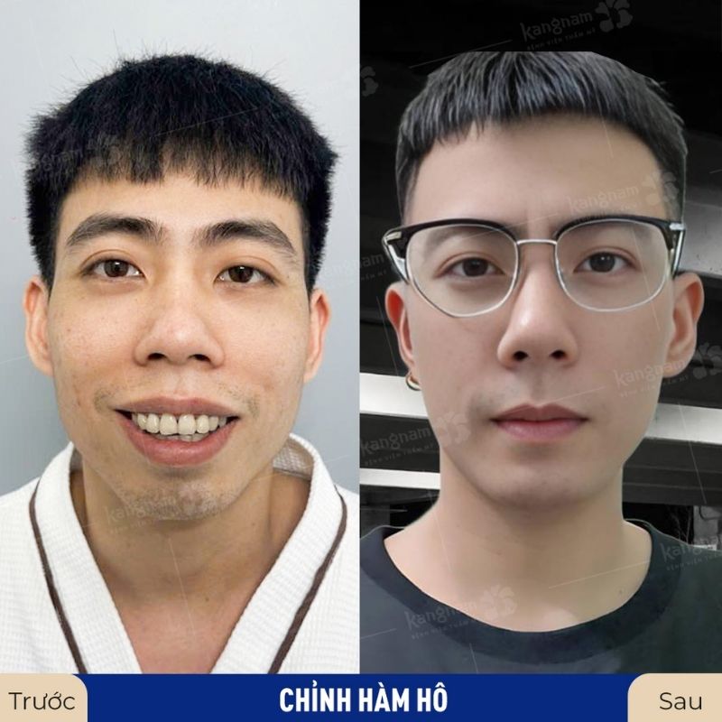 Kết quả phẫu thuật hàm có thể duy trì vĩnh viễn