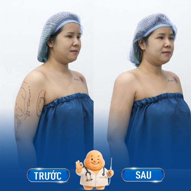 Phụ nữ sau sinh gặp tình trạng mỡ thừa, da chảy xệ
