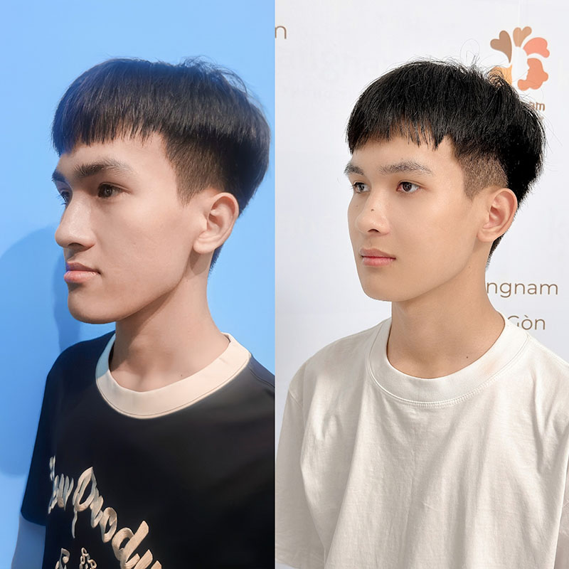 3-6 tháng tiếp theo xương dần ổn định