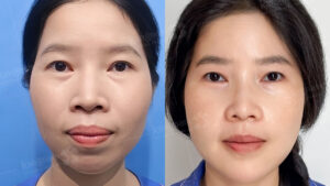 Chỉnh hình hàm mặt: Khi diện mạo thay đổi, cuộc sống cũng sang trang