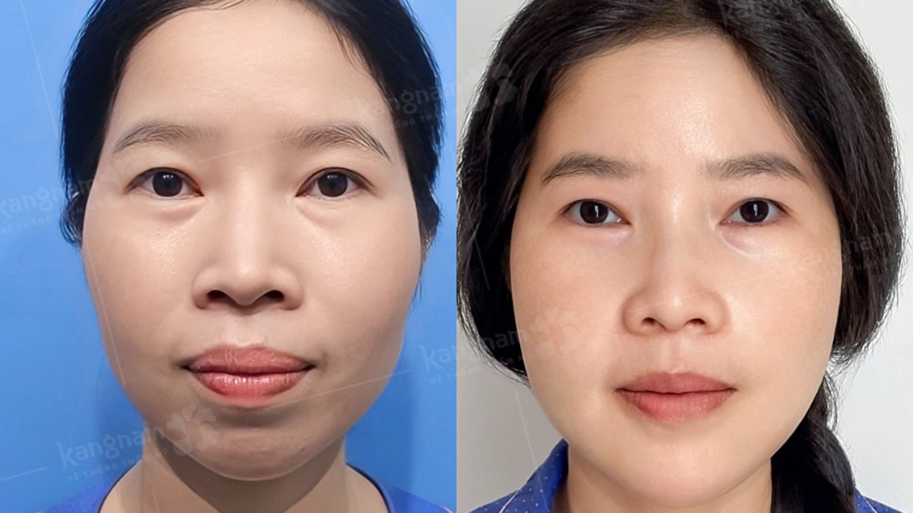 Chỉnh hình hàm mặt: Khi diện mạo thay đổi, cuộc sống cũng sang trang