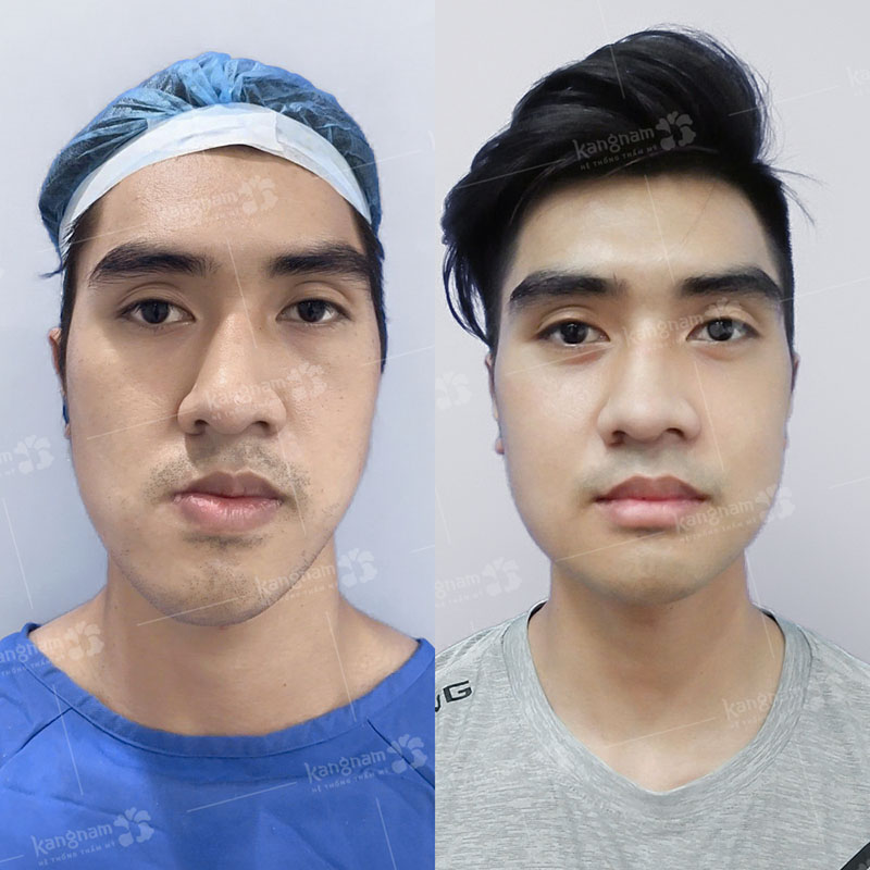 Khách hàng hàm móm, mặt lệch thay đổi sau khi phẫu thuật hàm