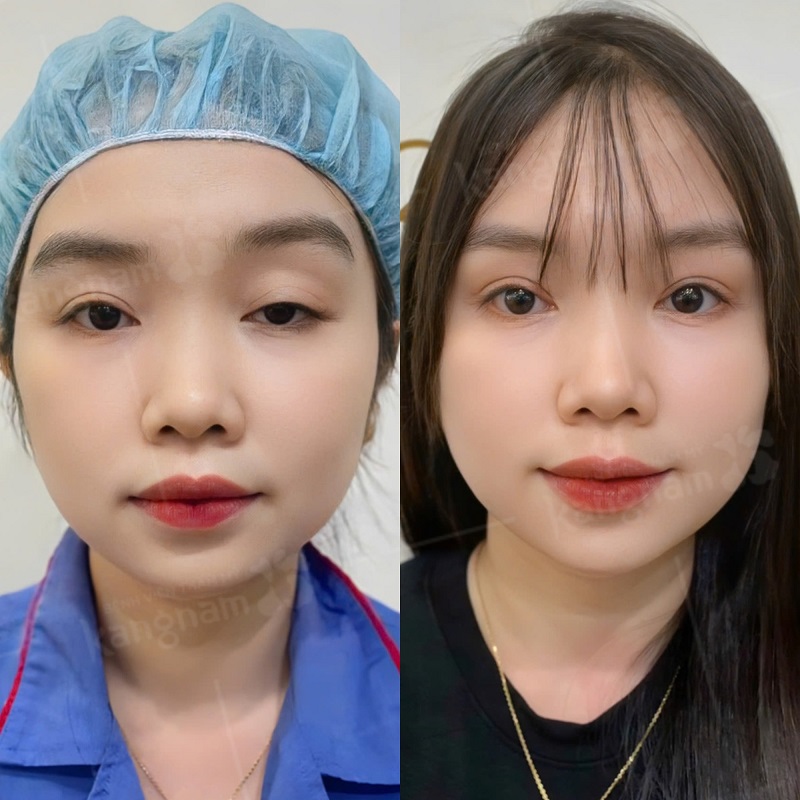 Cắt mí mắt có thể duy trì hiệu quả lâu dài