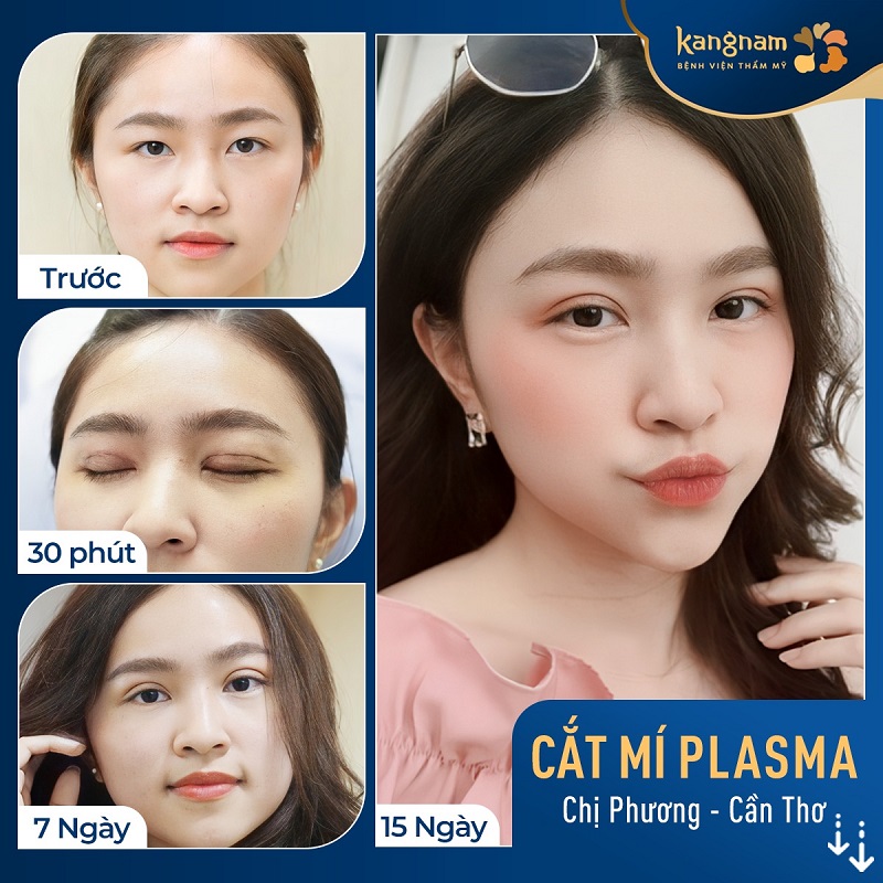 Cắt mí tại Kangnam mang lại đôi mắt hai mí tự nhiên, lâu bền