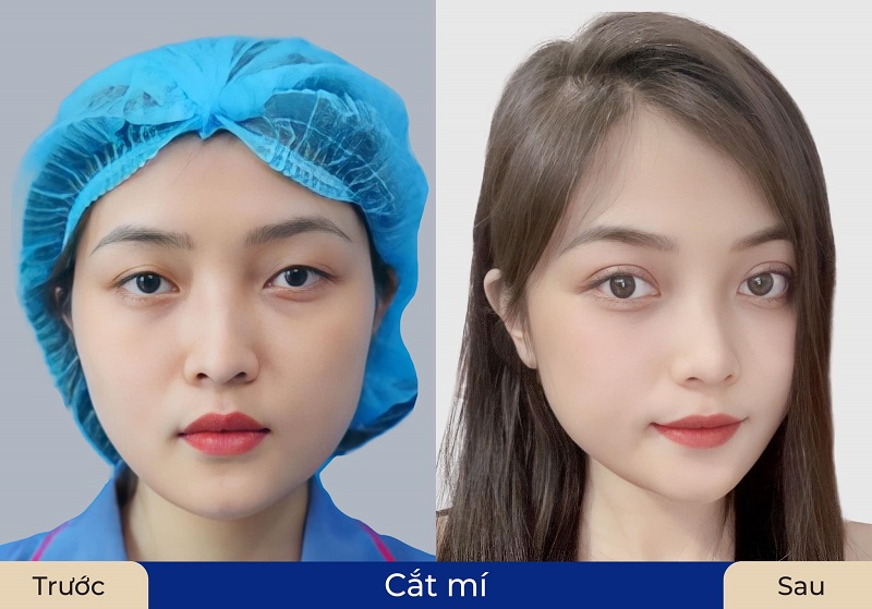 Hiệu quả cắt mí được duy trì lâu dài