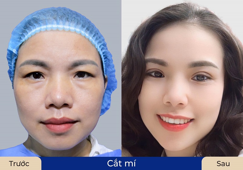 Mí mắt chùng nhão, có nhiều da dư