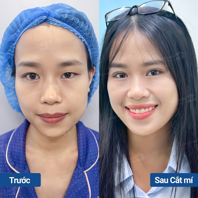 Cắt mí Perfect Eyes kỹ thuật cao giúp tạo nết mí sắc nét, rõ