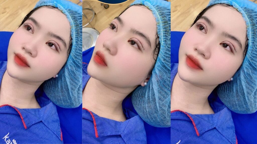 Chi phí thẩm mỹ mắt giá bao nhiêu? Bảng giá chi tiết