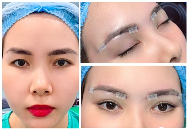 Combo treo chân cung mày kết hợp cắt mí