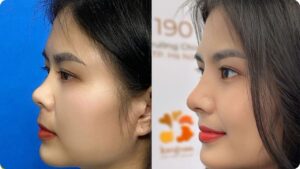 Sửa mũi ngắn hếch giá bao nhiêu? Bảng giá mới nhất