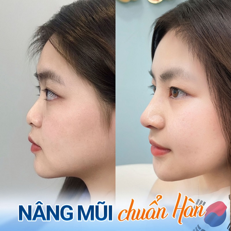 Dịch vụ nâng mũi chuẩn Hàn, sở hữu dáng mũi cao, thon gọn và tự nhiên