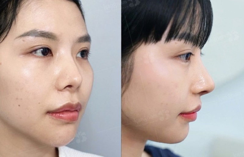 Nâng mũi giúp khắc phục tình trạng mũi gồ, mũi tẹt, mũi hỏng