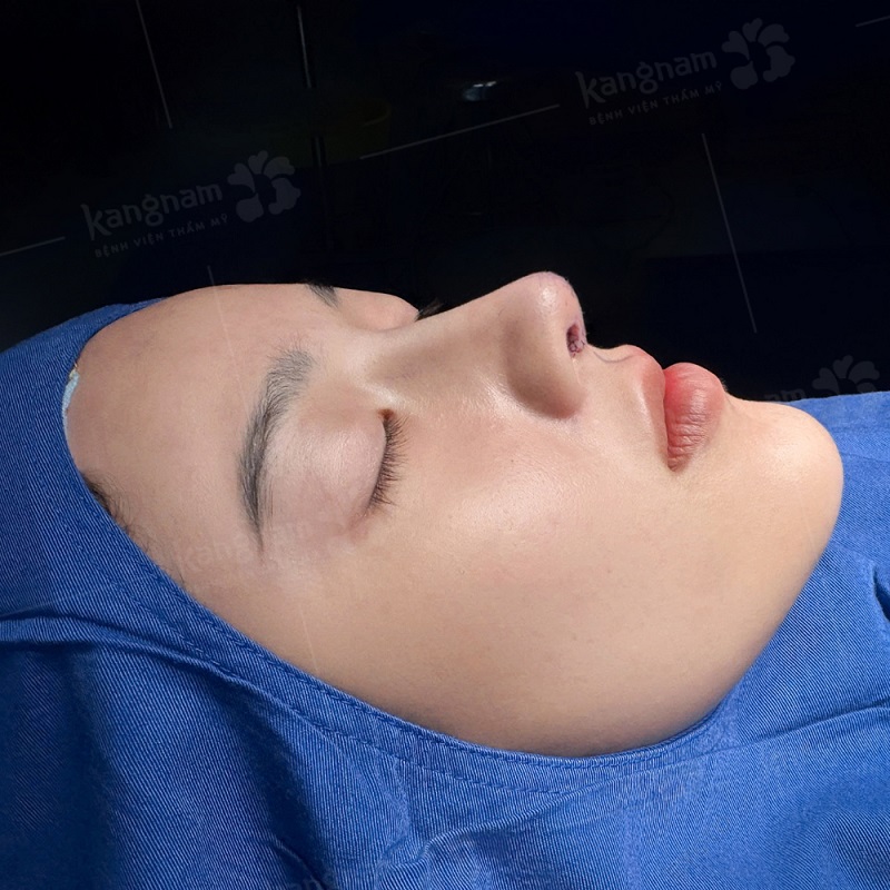 Nên hỏi bác sĩ những câu hỏi xung quanh nâng mũi