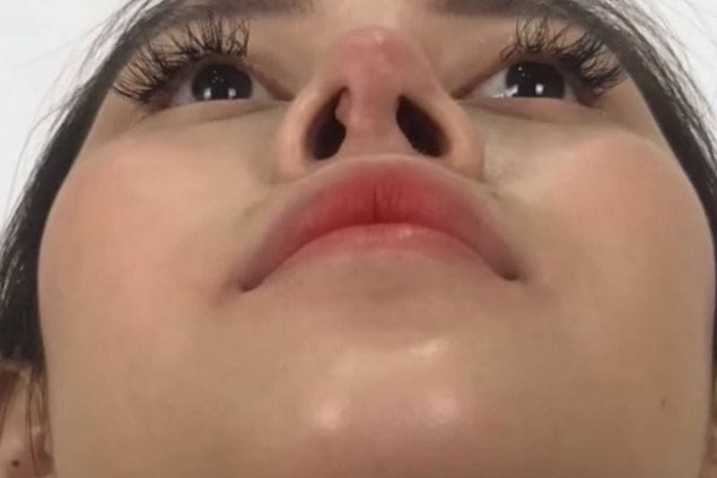 Mũi bị lòi sụn lộ rõ khi nhìn