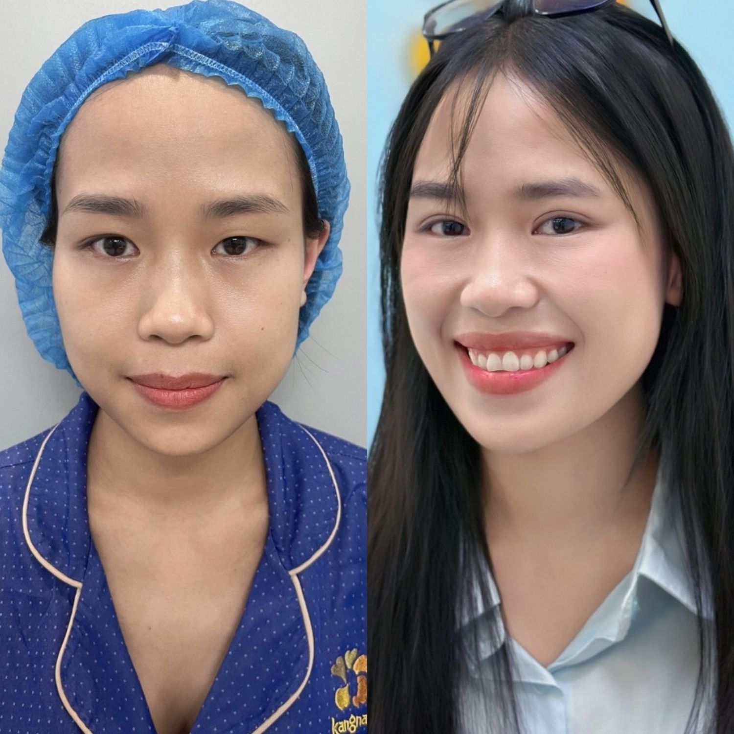 Nếp mí đều giúp gương mặt cân đối