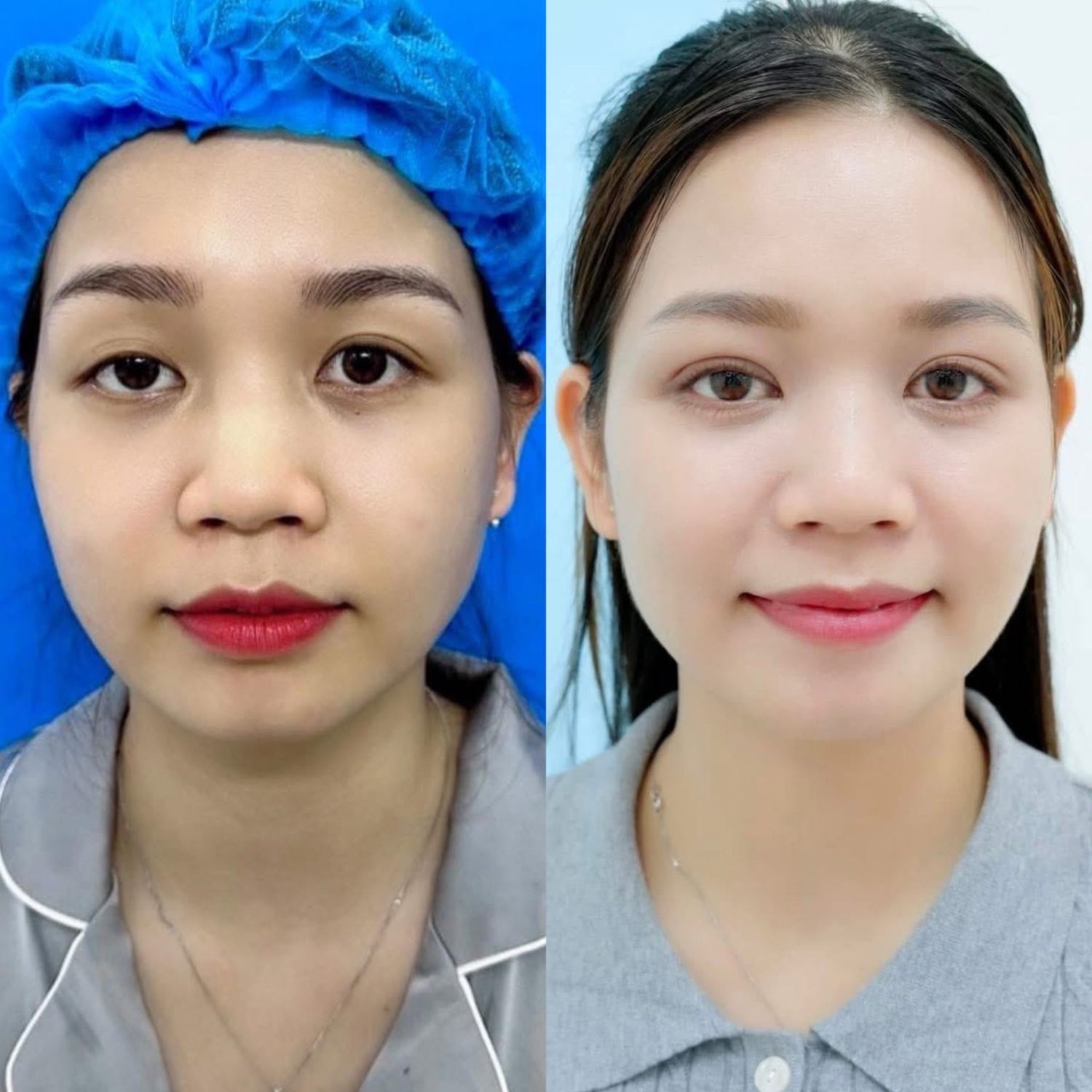 Tạo nếp mí cân đối