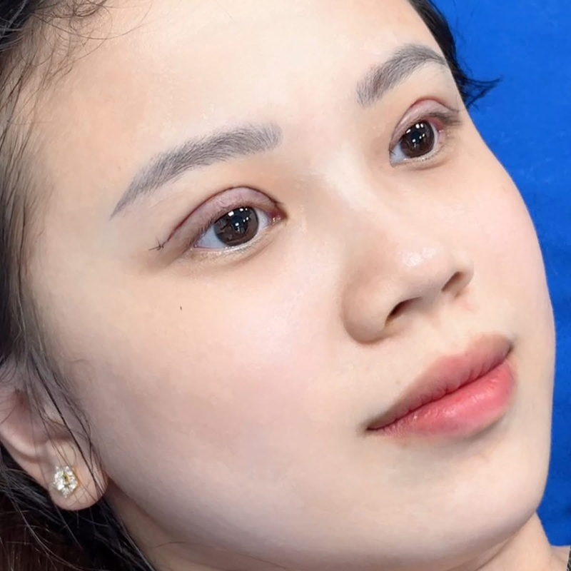 Đa dạng phương pháp cắt mí tại Kangnam TP.HCM