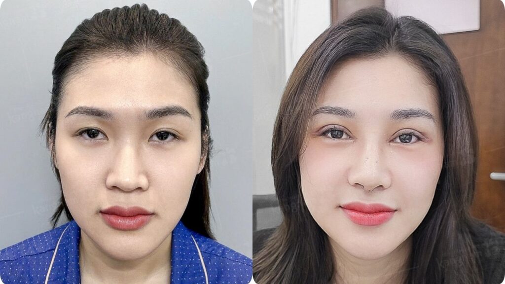 Chi phí nâng mũi giá bao nhiêu? Giá cụ thể theo từng phương pháp