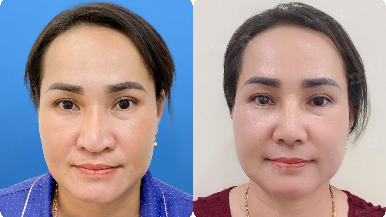 Mũi nâng lâu năm đã lộ sụn, cần thay sụn