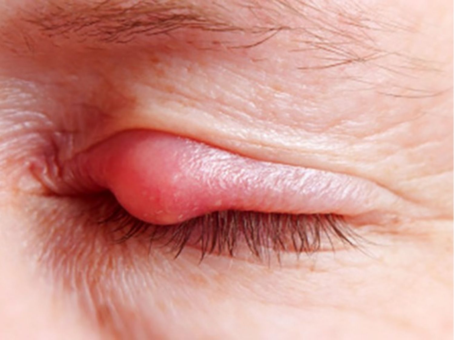 Mắt đang viêm, nhiễm trùng