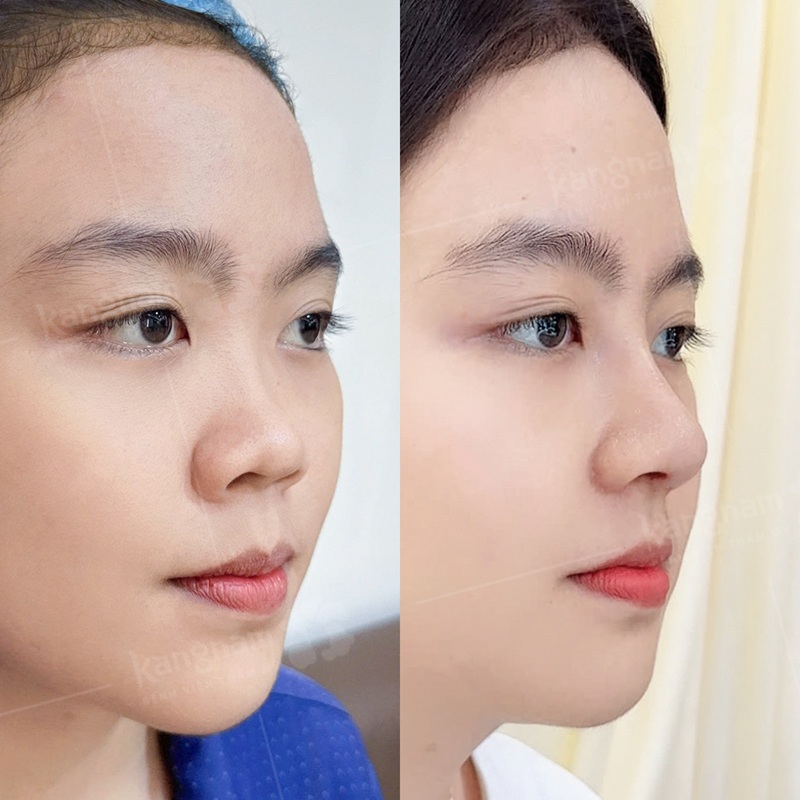 Nên làm mũi khi muốn cải thiện vẻ ngoài tự tin hơn