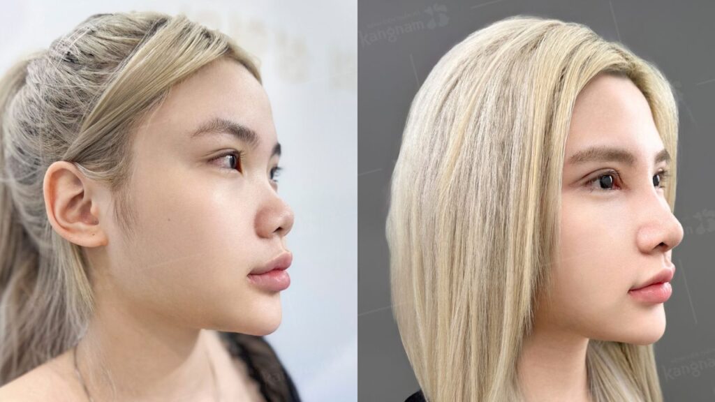 Có nên làm mũi không? Khi nào nên làm và khi nào không nên làm?