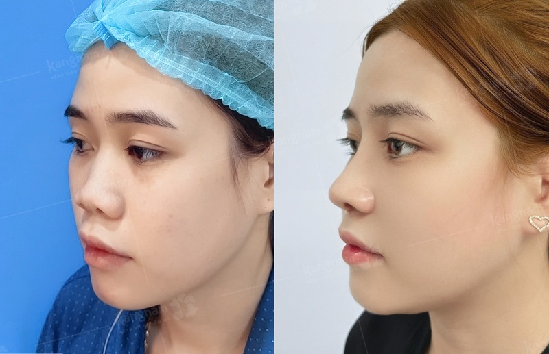 Nâng mũi an toàn, không phẫu thuật, hạn chế đau 