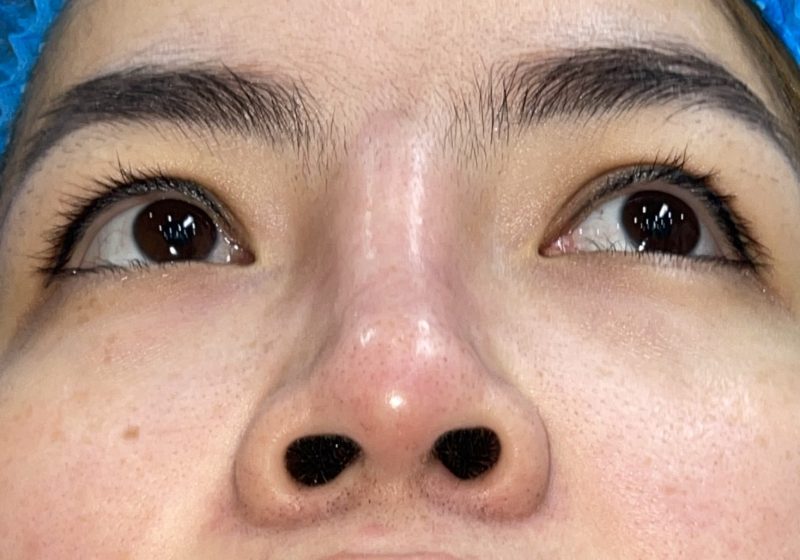 Mũi bị sưng, lệch không giống kỳ vọng