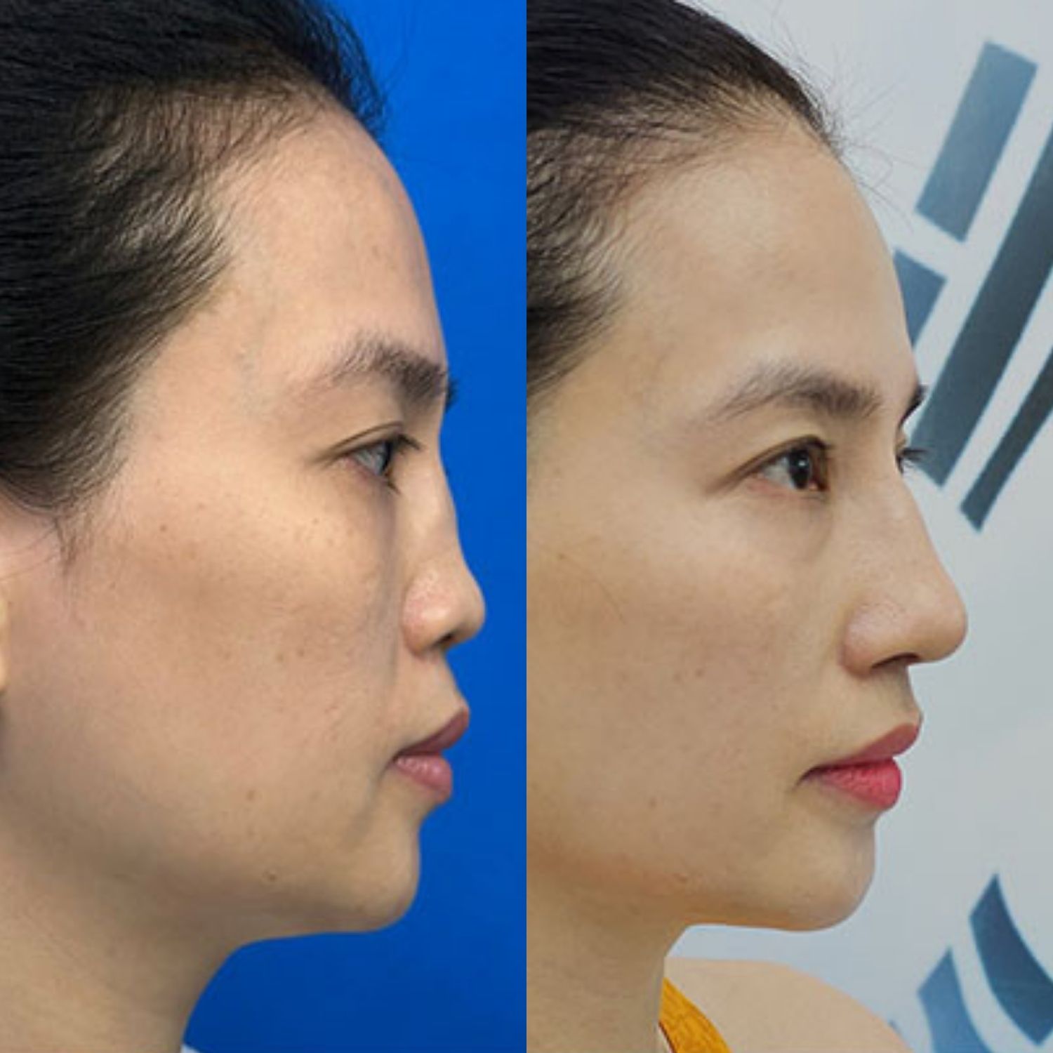 Giải cứu mũi lỗi, hỏng thành công