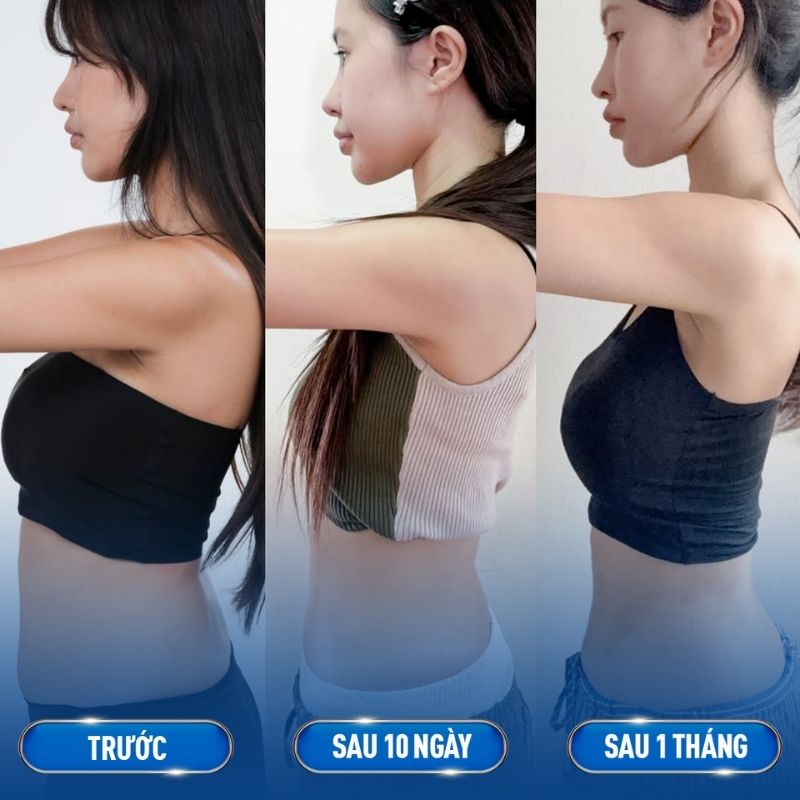 Giảm mỡ tay không cần tập luyện