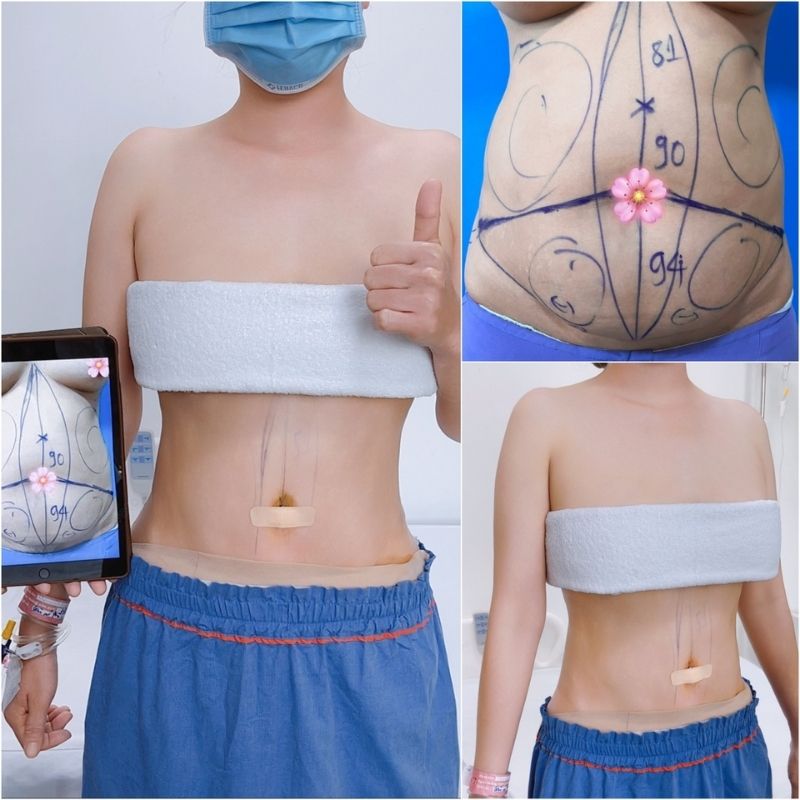 Giảm mỡ hiệu quả, không lồi lõm da