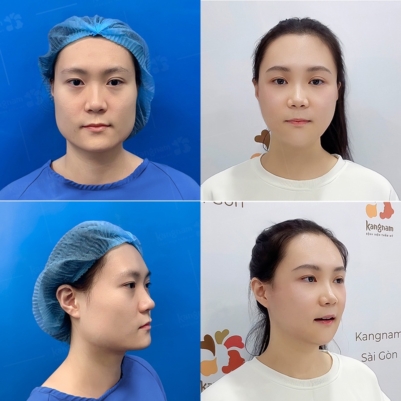 Kangnam Hà Nội địa chỉ gọt hàm uy tín được khách hàng lựa chọn