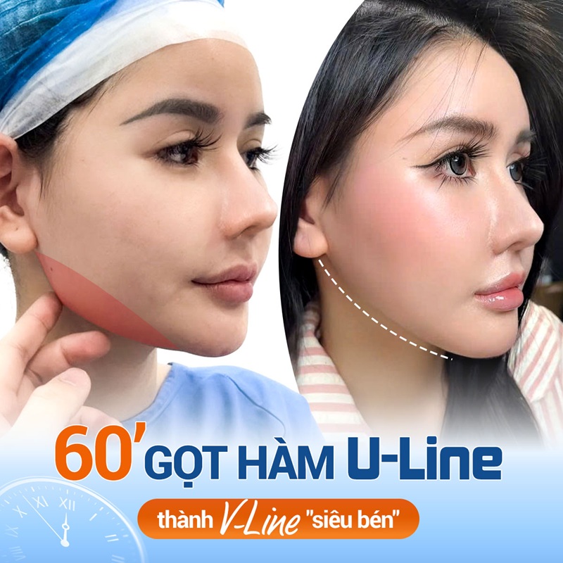 Gọt hàm nhanh chóng, an toàn sở hữu cằm VLine tại Kangnam Hà Nội