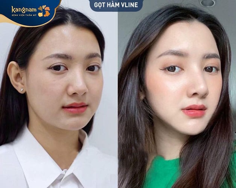 Khuôn mặt Vline, sắc gọn hơn