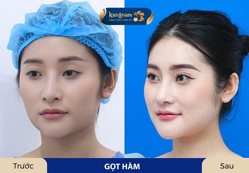 Giúp chị em tự tin với khuôn mặt gọn, nhìn vline hơn