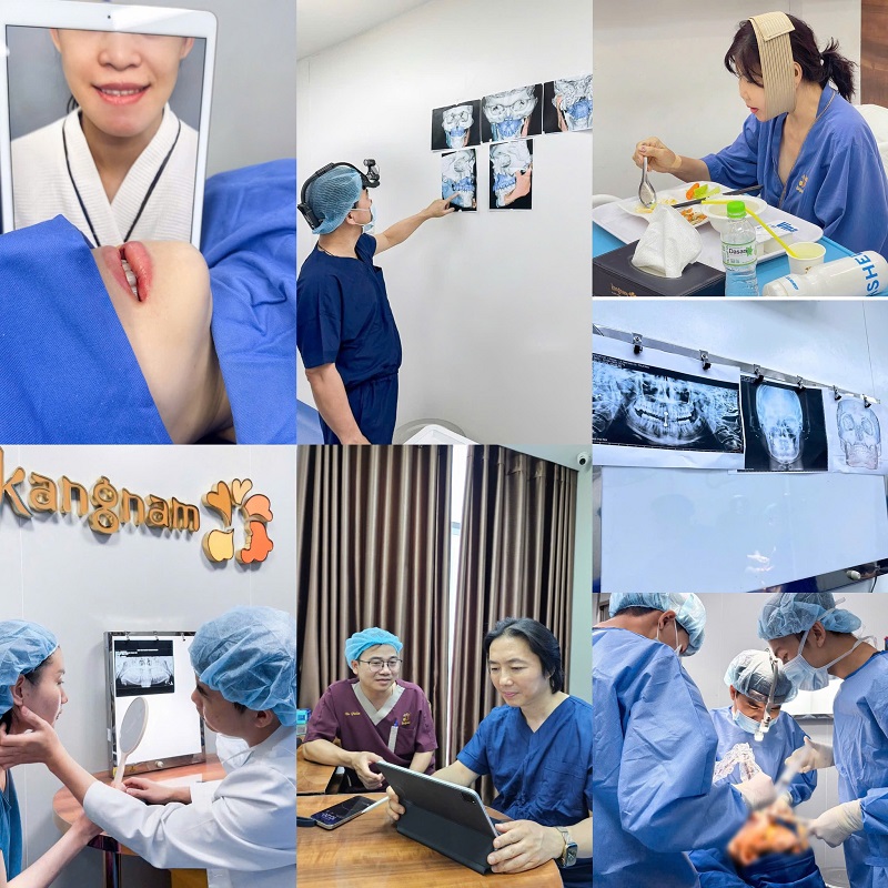 Quy trình gọt hàm an toàn tại Kangnam TPHCM