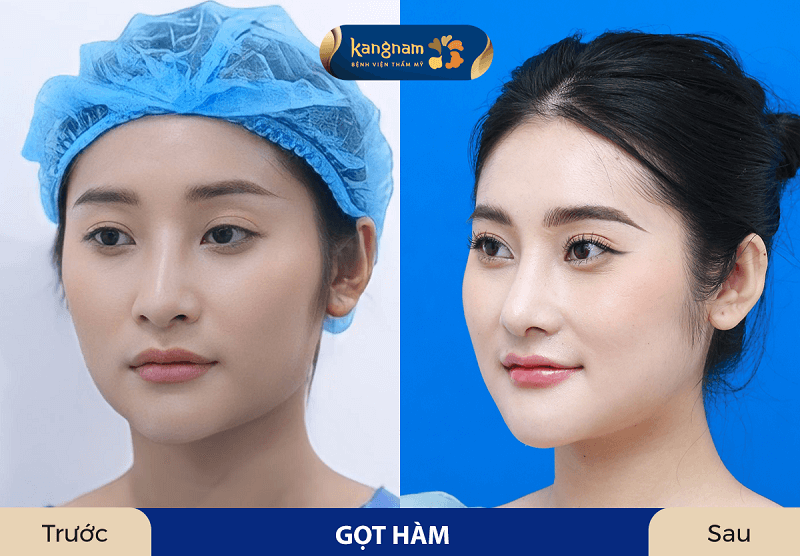 Gương mặt Vline, thon gọn và cân đối