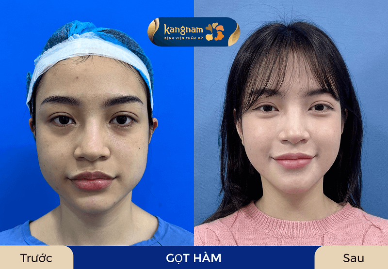 Gọt hàm tại Kangnam TPHCM được nhiều khách hàng đánh giá cao