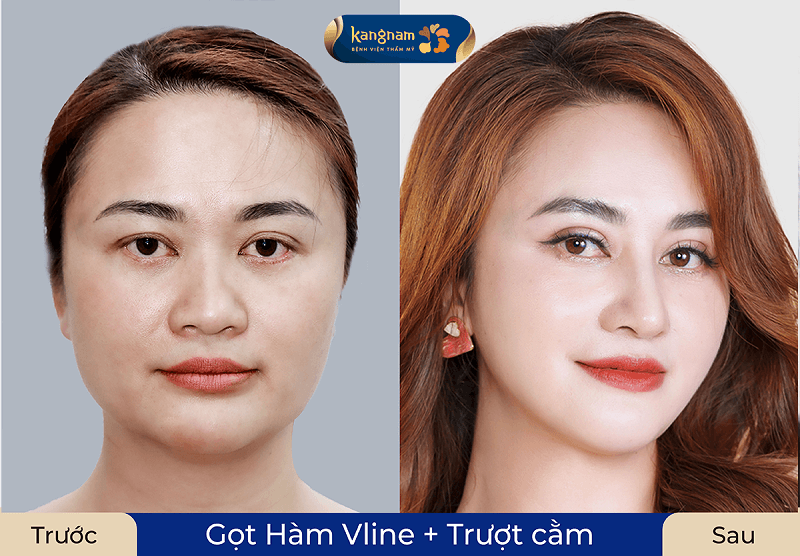 Khách hàng thực hiện combo dịch vụ giúp gương mặt thanh thoát