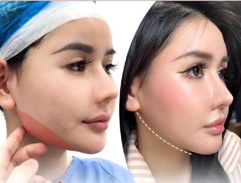 Gọt hàm khắc phục tình trạng xương hàm to, bạnh